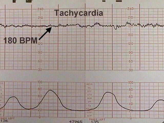 Baby retailer heart rate and contraction monitor